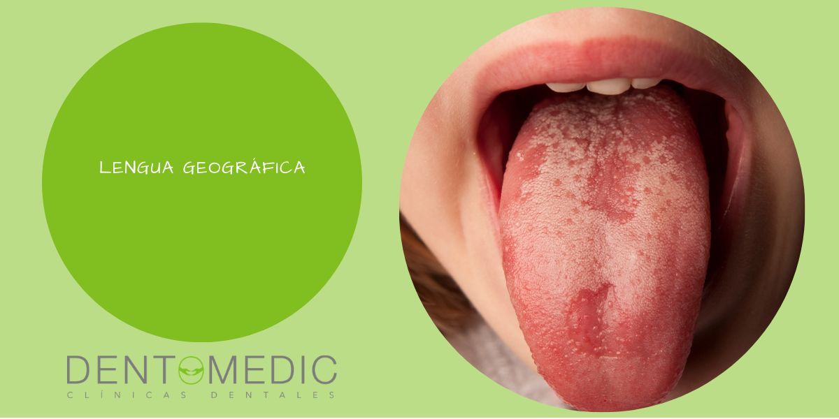 Glotis migratoria benigna