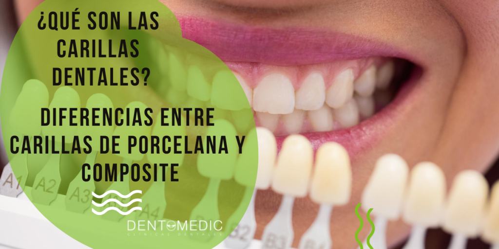 Carillas dentales