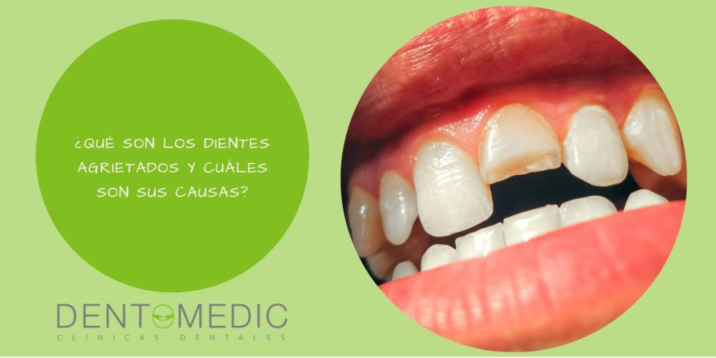 ¿Qué son los dientes agrietados y cuáles son sus causas?