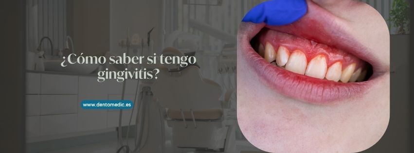 como saber si tengo gingivitis