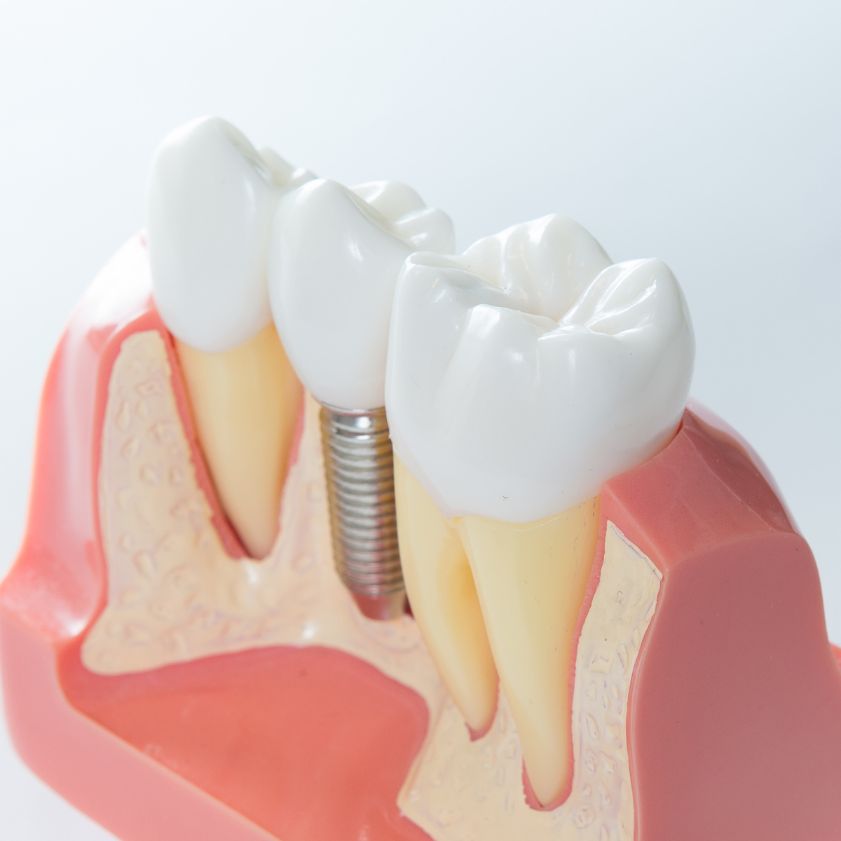 implantes dentales en Palencia