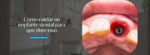 Cómo cuidar un implante dental