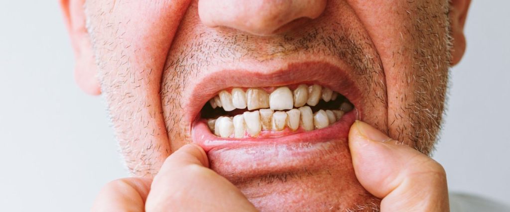 dientes con sarro
